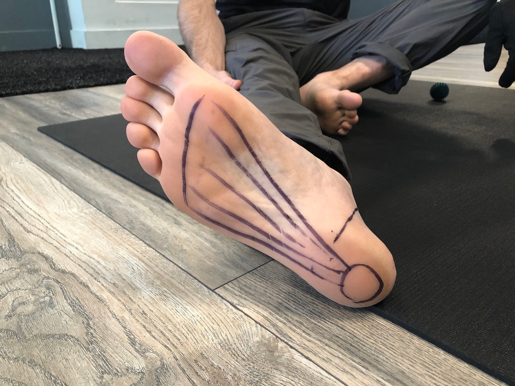 Foot Pain Plantar Fascia